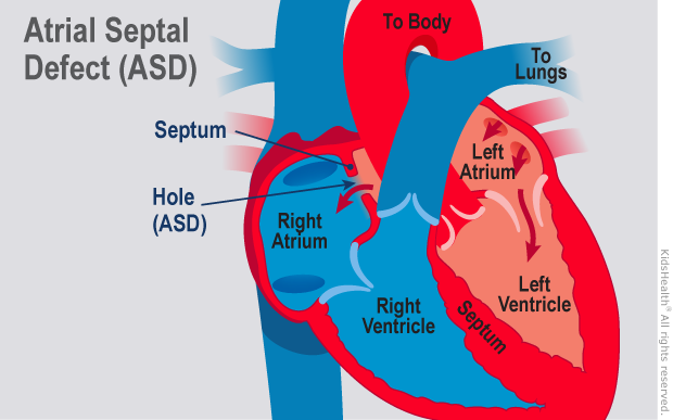 Diagram shows the inside of a heart with an atrial septal defect (A S D) as described in the article text.