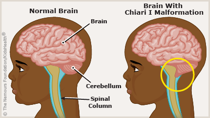 Illustration shows a normal brain and a brain with a Chiari I malformation