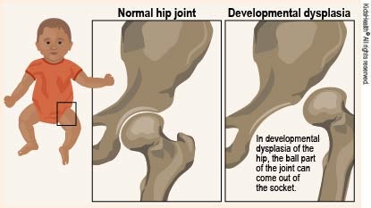 Diagram shows the inside of a normal hip joint compared with a hip joint with developmental dysplasia. In a hip with developmental dysplasia, the ball part of the joint can come out of the socket, as explained in the article.