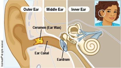Diagram of the outer ear, middle ear, and inner ear showing earwax (also called cerumen) in the ear canal that leads to the eardrum, as explained in the article.
