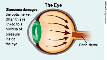 When pressure builds inside the eye, it can lead to glaucoma, as explained in the article.