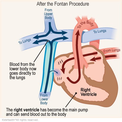 Illustration: After the Fontan Procedure