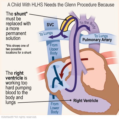 Illustration: A child with HLHS needs the Glenn Procedure because