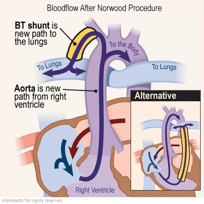 Illustration: After the Norwood procedure, blood reaches the lungs through the shunt.