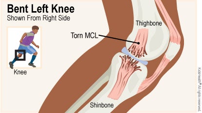 Diagram shows bent left knee shown from right side and labels torn MCL, thighbone, and shinbone