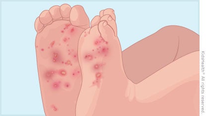 Illustration shows scabies sores on a child's feet, as described in the article