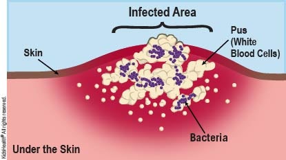 Diagram showing bacteria and pus under the skin, forming an abscess.