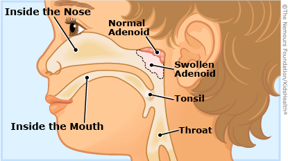 adenoidal hypertrophy illustration