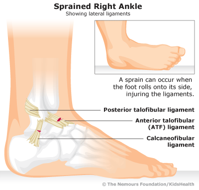 sprained right ankle illustration