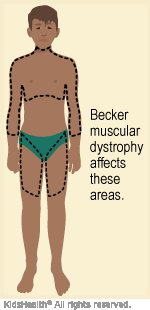 Illustration: areas affected by Becker muscular dystrophy
