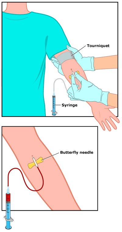 Blood draw showing tourniquet, syringe, and butterfly needle, as described in the article text.