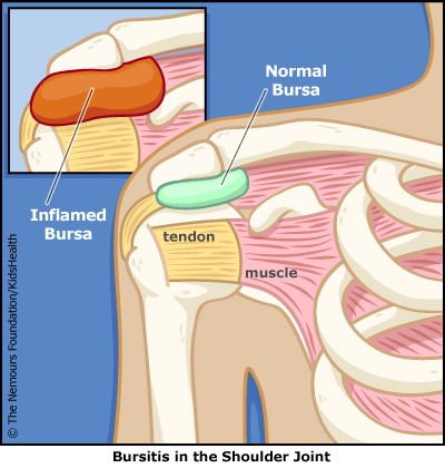bursitis shoulder joint