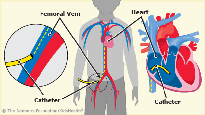 cardiac catheterization illustration