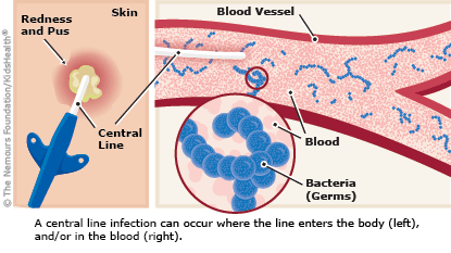 Signs of an infected central line include pus and skin redness, as explained in the article.