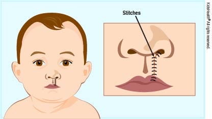 Picture of a baby's face with stitches under the nose. Close up of the nose and mouth area showing the stitches.