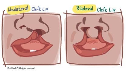 Diagram showing a unilateral cleft lip and a bilateral cleft lip, as described in the article.
