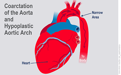 Illustration: Coarctation of the Aorta