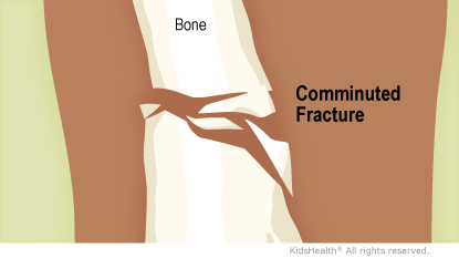 Illustration: Comminuted fracture