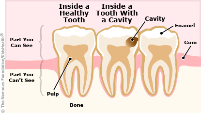 Inside a healthy tooth and inside of one with a dental cavity