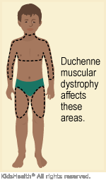 Illustration: Areas affected by Duchenne muscular dystrophy