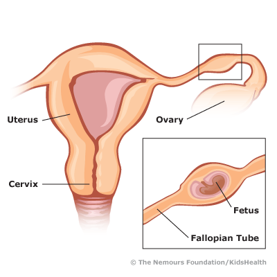 The fetus is implanted in the fallopian tube, between the ovary and the uterus.
