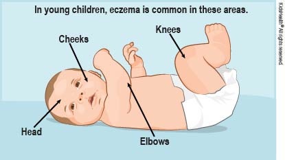 In young children, eczema is common in these areas: head, cheeks, elbows, knees.