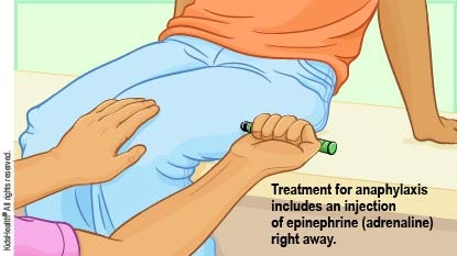 Treatment for anaphylaxis includes an injection of epinephrine (adrenaline) right away.