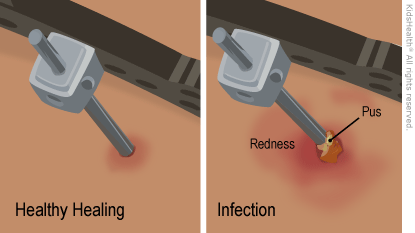 Illustration: External fixator pin site infection
