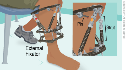 Illustration: External Fixator Close Up