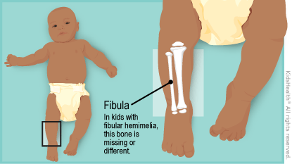 Illustration: fibula shown on a baby's leg