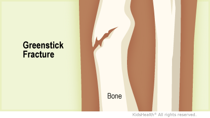Illustration: Greenstick fracture