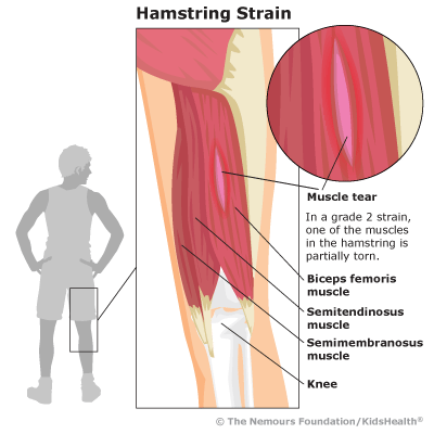 hamstring_strain_illustration
