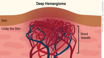 Illustration: Deep Hemangioma