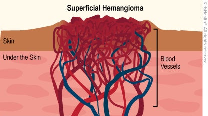 Illustration: Superficial Hemangioma