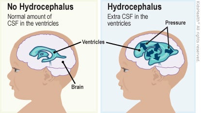 First diagram is no hydrocephalus and shows brain and ventricles with normal amount of CSF in the ventricles. Second diagram is hydrocephalus and shows brain, venticles, increased pressure in ventricles with extra CSF in the ventricles.