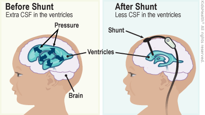 First diagram is before shunt with extra CSF in the ventricles. Second diagram is after shunt with less CSF in the ventricles and shows the shunt in the ventricles.