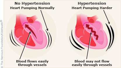 No hypertension, heart pumping normally, blood flows easily through vessels. Hypertension, heart pumping harder, blood may not flow easily through vessels.