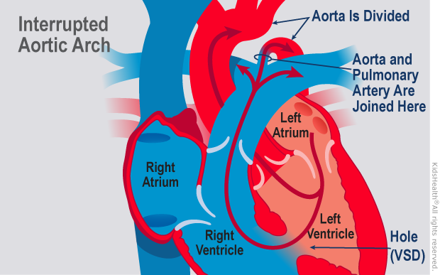 Illustration: interrupted aortic arch