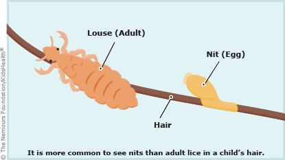 Head lice adult and nit on hair