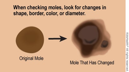 Check moles for changes