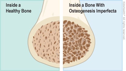 Illustration: Inside a bone with osteogenesis imperfecta