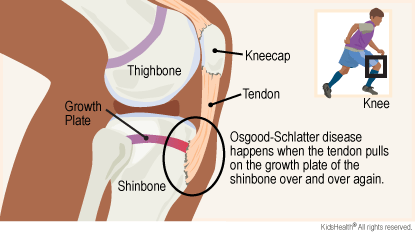 Diagram shows the knee, kneecap, tendon, thighbone, shinbone, and shinbone growth plate. Osgood-Schlatter disease happens when the tendon pulls on the growth plate of the shinbone over and over again