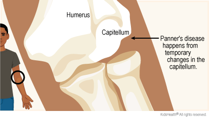Diagram of bones of elbow. Humerus and capitellum are labeled. Arrow points to capitellum and says Panner's disease happens from temporary changes in the capitellum.