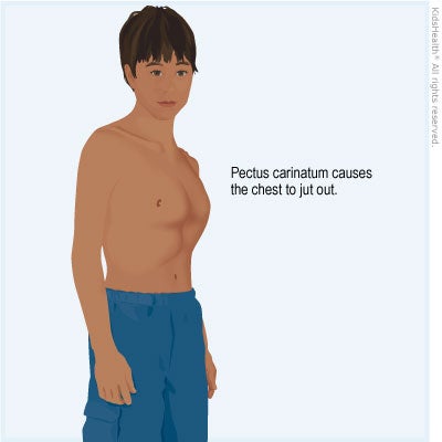 Illustration: Pectus carinatum causes the chest to jut out.