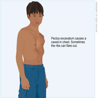 Illustration: Pectus excavatum causes a caved-in chest. Sometimes the ribs can flare out.