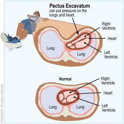 Illustration: Pectus excavatum pressure on heart and lungs