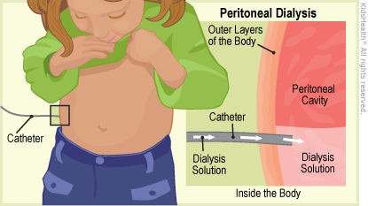 Illustration: Peritoneal Dialysis
