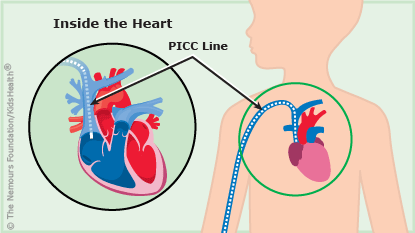 A PICC line is shown under a child's skin near the heart.