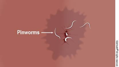  Diagram showing pinworms around the anus.