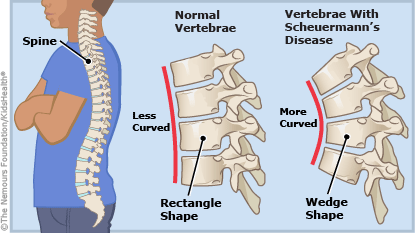 Illustration showing how the vertebrae with Scheuermanns disease is more curved than normal vertebrae.